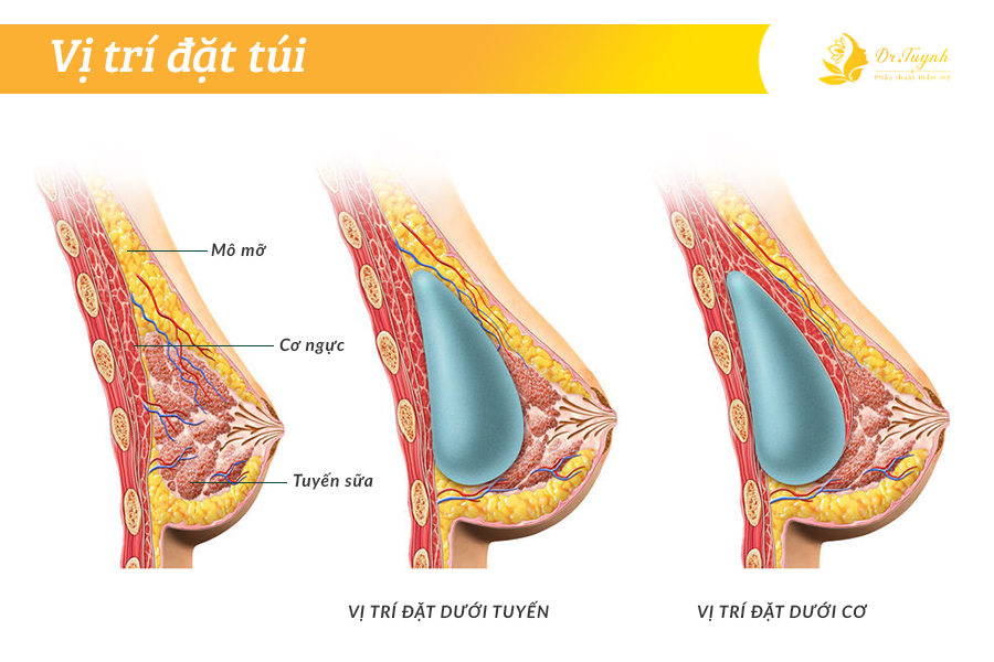 vi-tri-dat-tui-nguc