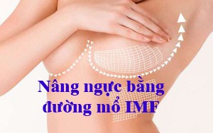 NHỮNG ƯU ĐIỂM CỦA KỸ THUẬT NÂNG NGỰC ĐƯỜNG CHÂN NGỰC (ĐƯỜNG IMF)