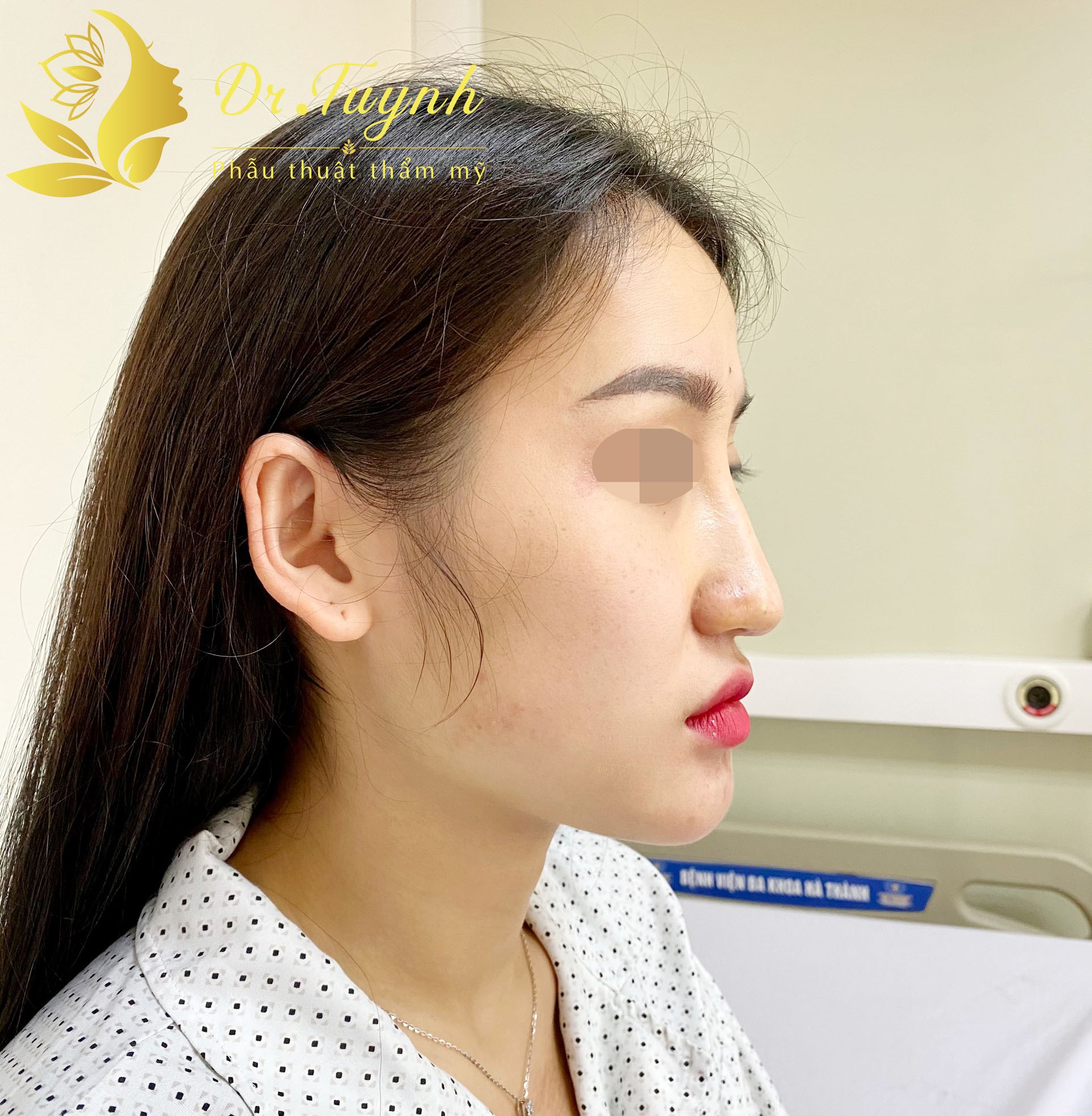 01 BIẾN CHỨNG XA THƯỜNG GẶP CỦA NÂNG MŨI: ĐẦU MŨI GỤC (Nhân 1 ca sửa mũi cảu của Bác sĩ Phan Tuynh)