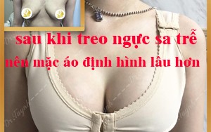 SAU MỔ THẨM MỸ NGỰC PHÌ ĐẠI - SA TRỄ, NÊN MANG ÁO ĐỊNH HÌNH KÉO DÀI - LỜI KHUYÊN CỦA BÁC SĨ