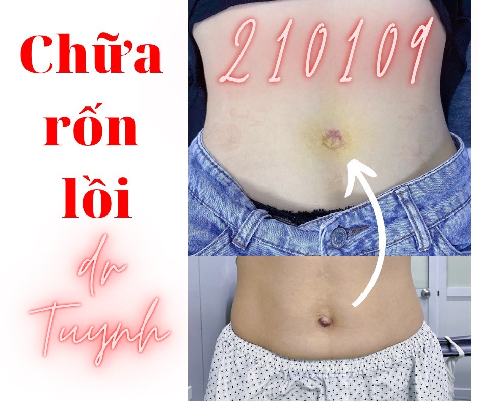 Thoát vị rốn và Thẩm mỹ rốn (Thẩm mỹ rốn phần 2)