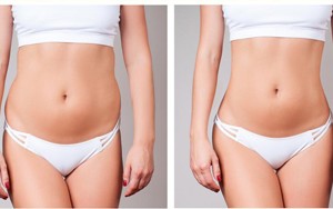 BIẾN CHỨNG LỒI LÕM SAU HÚT MỠ - NHỮNG ĐIỂM QUAN TRỌNG BẠN NÊN BIẾT