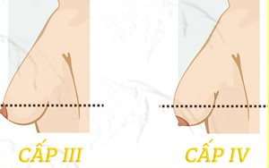 NGỰC SA TRỄ: CẢI TIẾN KỸ THUẬT MANG LẠI HIỆU QUẢ THẨM MỸ HƠN DO ÍT SẸO