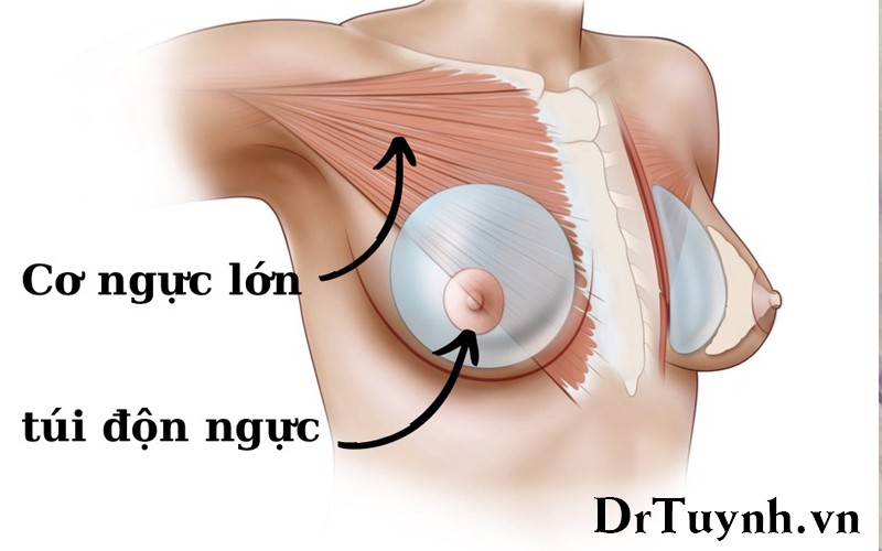 Nâng ngực đường chân ngực tại sao lại là đường phẫu được ưu tiên nhất (các dịch vụ nâng ngực: phần 1)