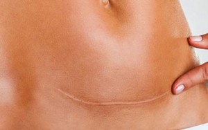 BIẾN CHỨNG DOG EAR CỦA SẸO PHẪU THUẬT LÀ GÌ? CÓ NÊN SỬA KHÔNG?