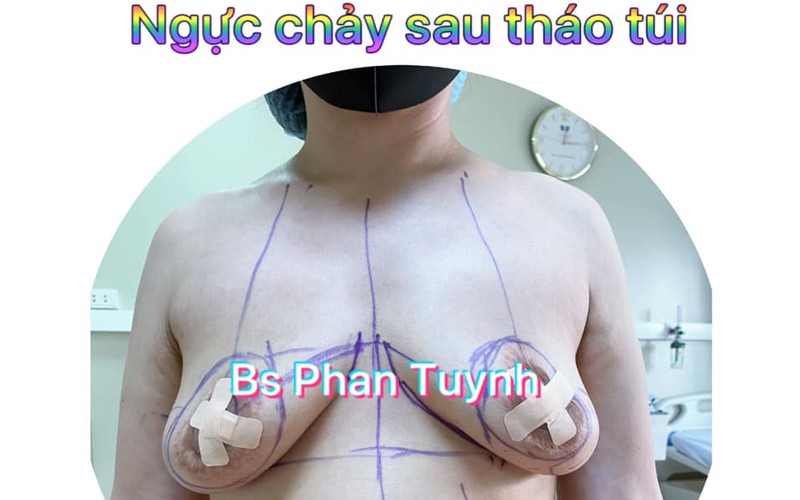 nguc-chay-sau-thao-tui