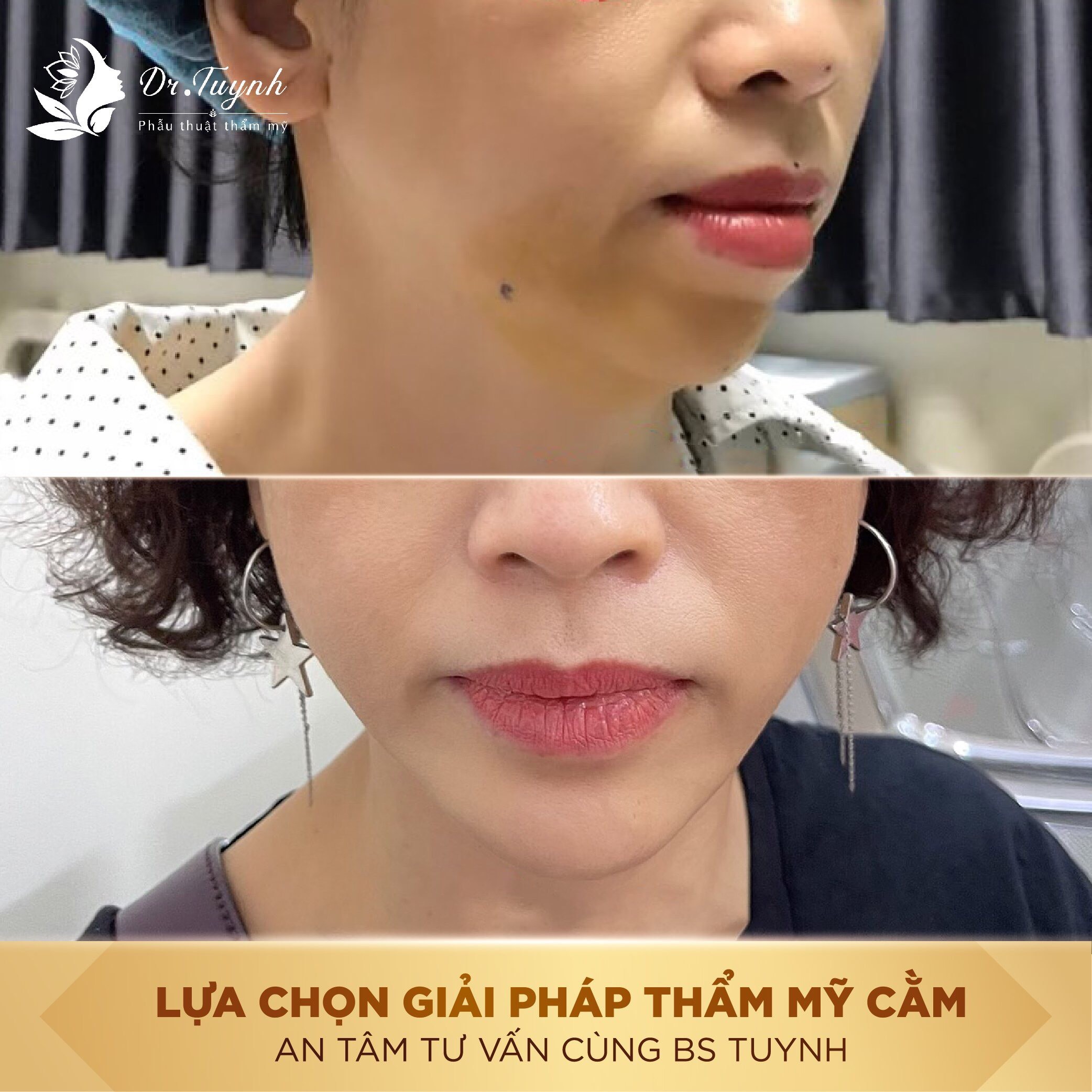 TẠI SAO NÊN ƯU TIÊN LỰA CHỌN PHẪU THUẬT ĐỘN CẰM? (Bài phân tích của Bác sĩ Phan Tuynh)