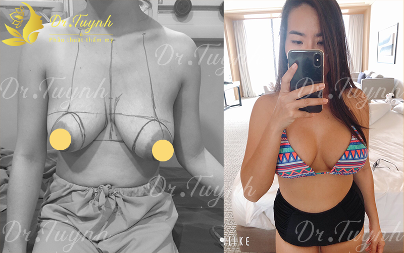 anh-tuyet