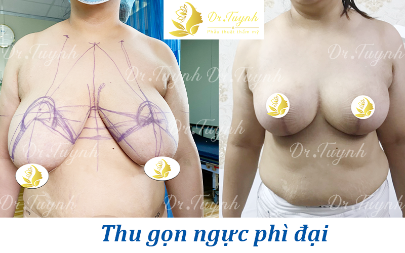 tuynh-sa-tre-web