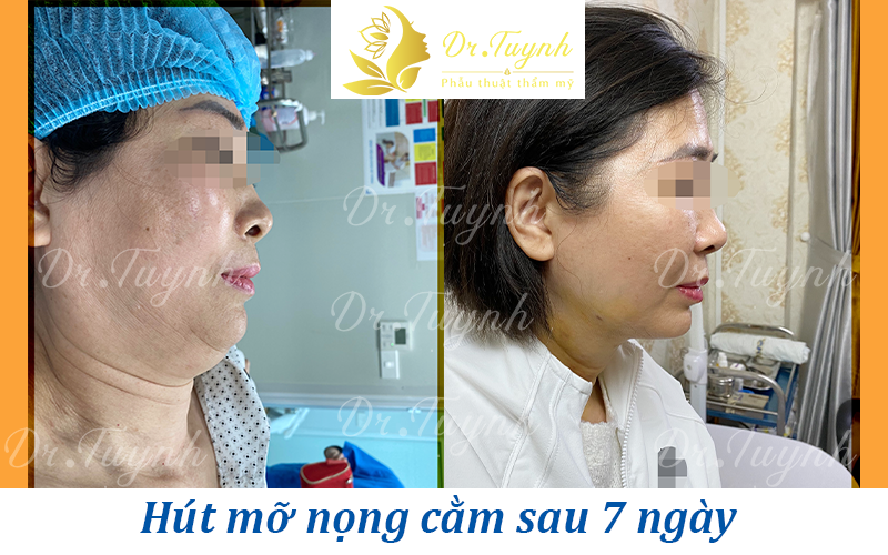 cam-tuynh