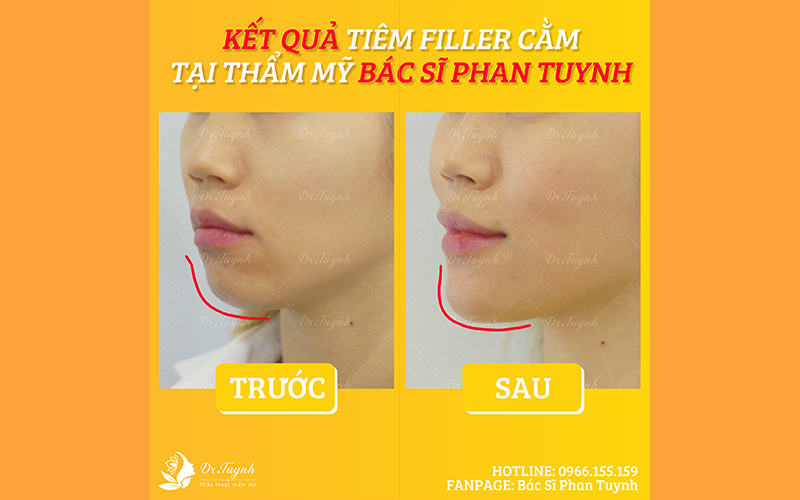 filler-cam-drtuynh