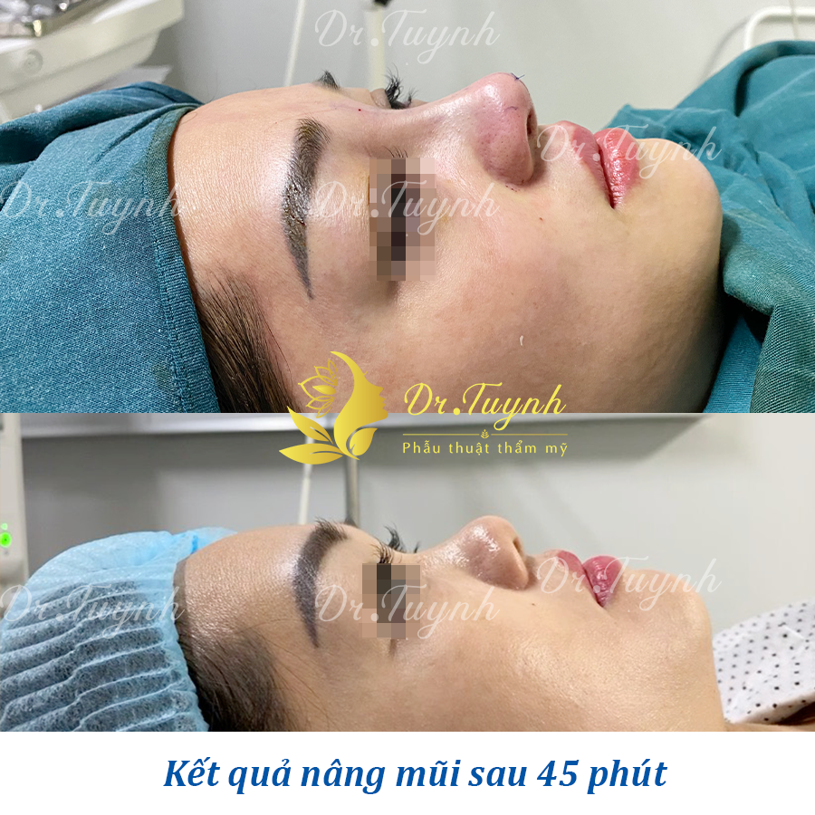 NHỮNG CHẤT LIỆU ĐƯỢC SỬ DỤNG TRONG NÂNG MŨI BẠN NÊN TÌM HIỂU (Những điều cần biết khi nâng mũi - phần 4)