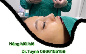Gây mê để phẫu thuật nâng mũi - ưu điểm nổi trội là gì?