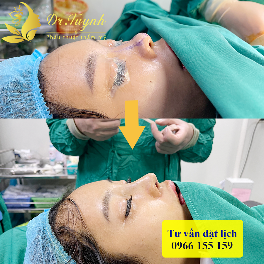 Người đi nâng mũi nhất định phải biết: Cách chăm sóc mũi