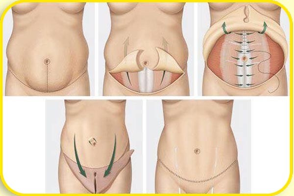 ky-thuat-cang-da-bung-drtuynh
