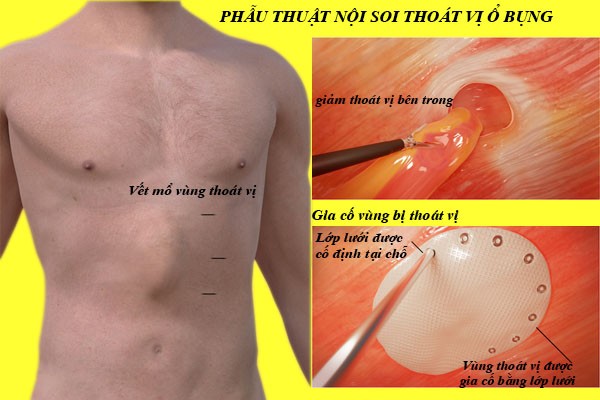 phau-thuat-noi-soi-thoat-vi-o-bung