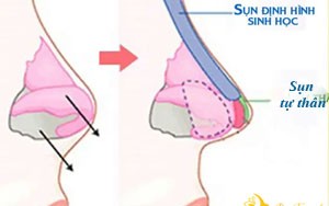 TỤT SỤN MŨI SAU NÂNG MŨI CÓ THỰC SỰ ĐÁNG SỢ?