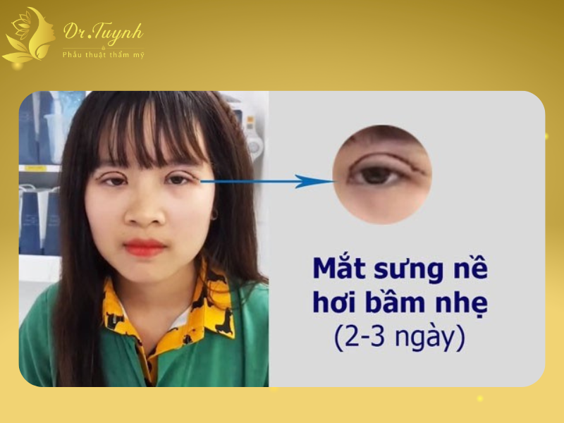 Sau cắt mí 2-3 ngày