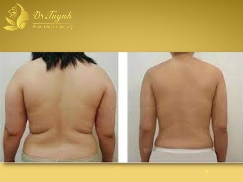 Hút mỡ lưng vai