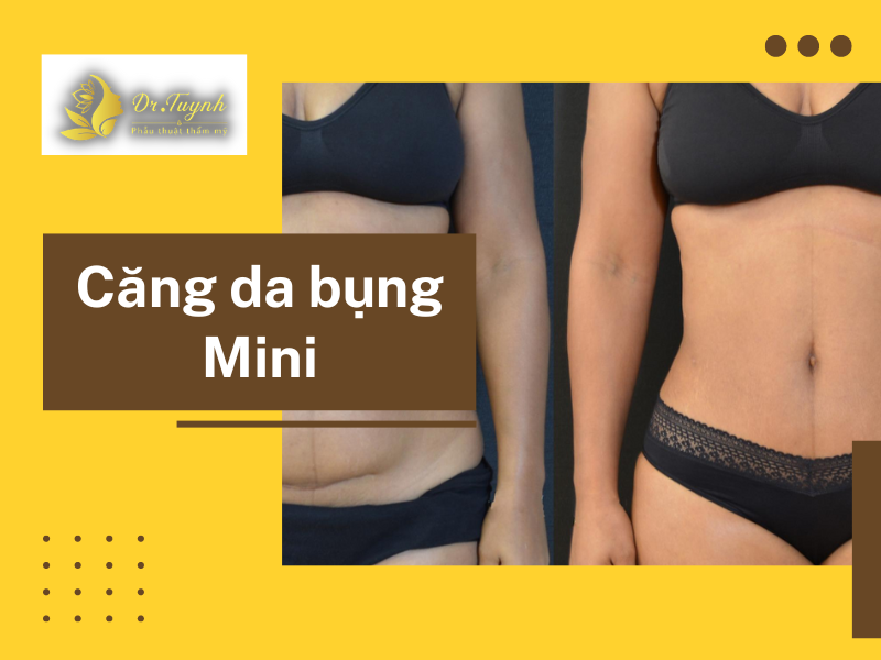 Phẫu thuật căng da bụng mini