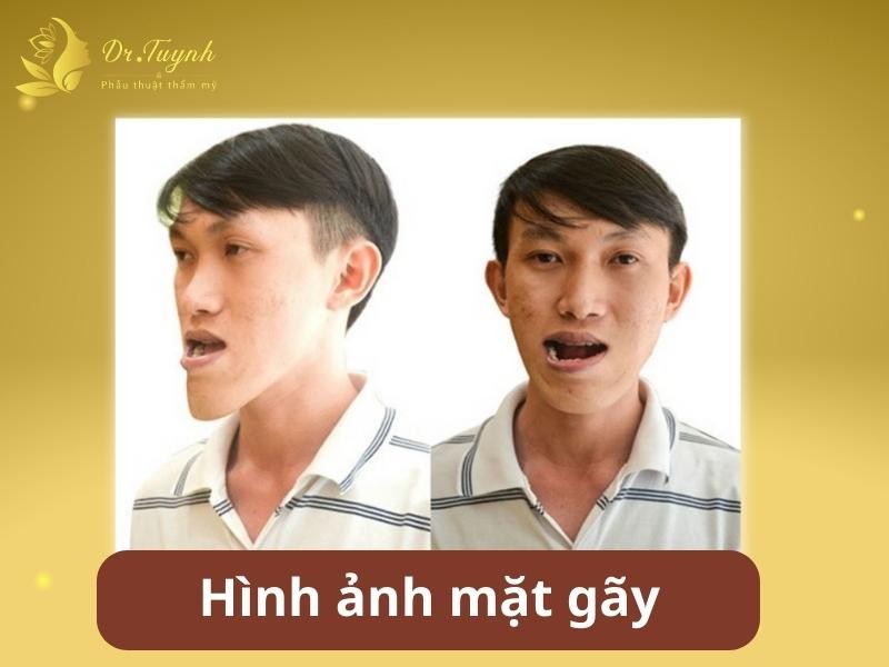 hinh-anh-mat-gay-1