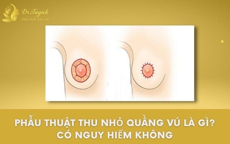 ứng dụng kỹ thuật treo sa trễ quanh quầng ti cho những mức độ sa trễ nào?