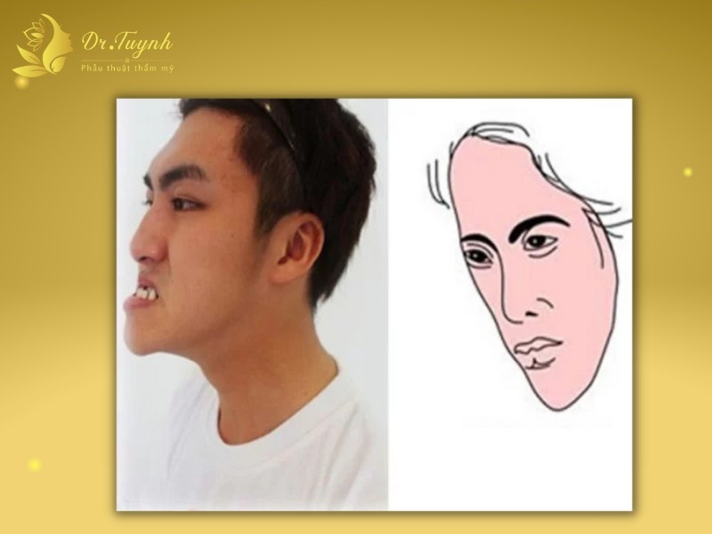 tuong-so-nguoi-mat-gay