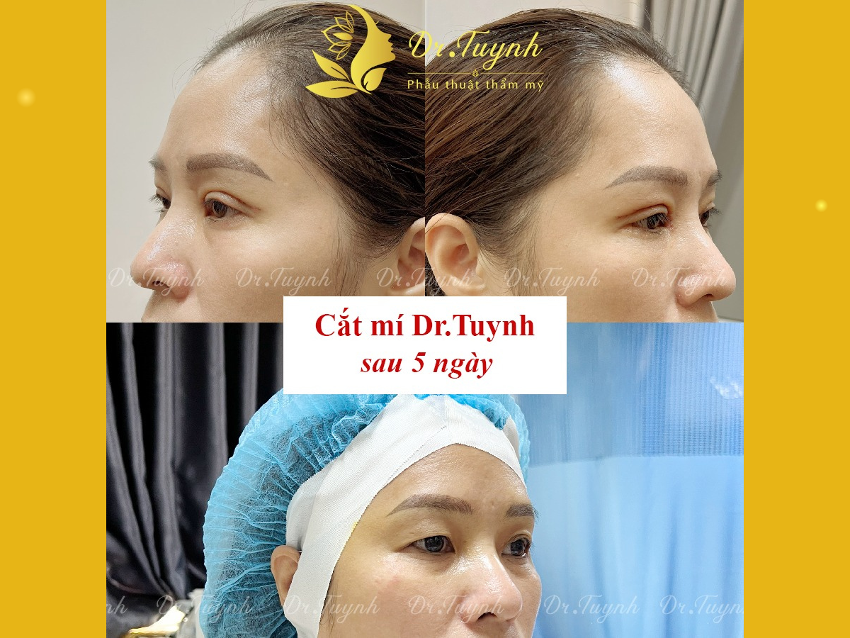 cat-mi-mini-deep-co-duoc-vinh-vien-khong-7