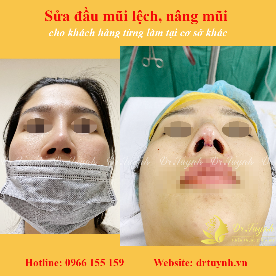 dựng trụ mũi, sửa mũi