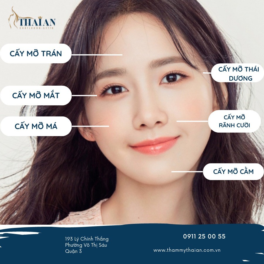 Cấy mỡ sưng bao lâu