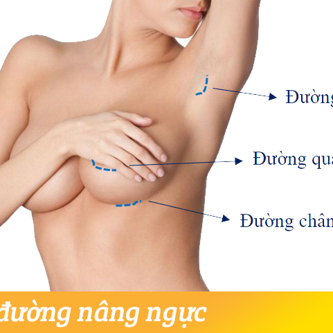 Nâng ngực đường nào không lộ sẹo