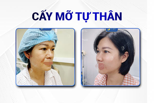 cay-mo-tu-than-truoc-sau