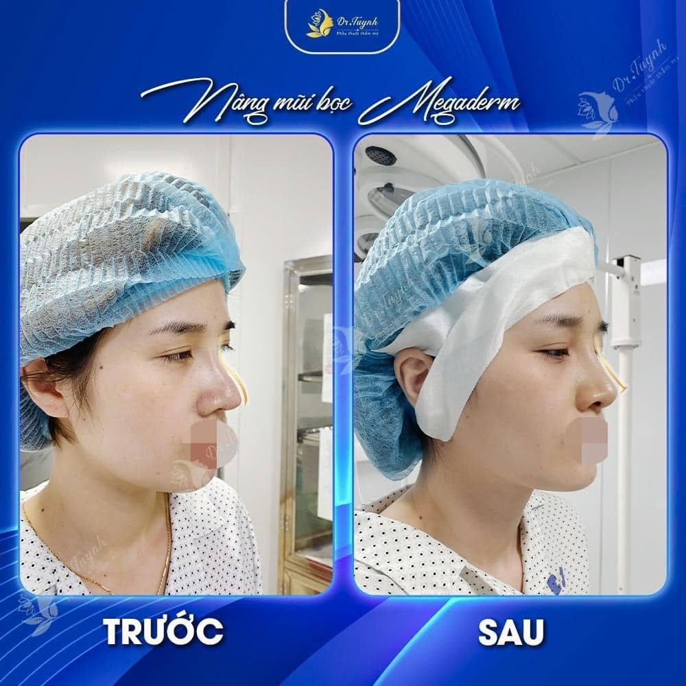SỬA MŨI GẤP DO DỌA THỦNG DA ĐẦU MŨI, MỘT CA LÂM SÀNG