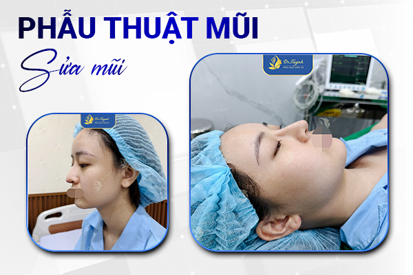 phau-thuat-mui-truoc-sau