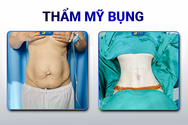 tham-my-bung-truoc-sau