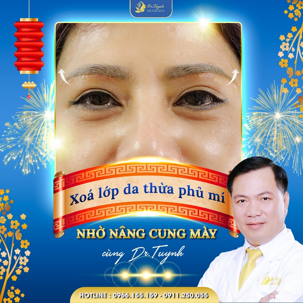 Hướng dẫn chăm sóc vết thương sau nâng cung mày