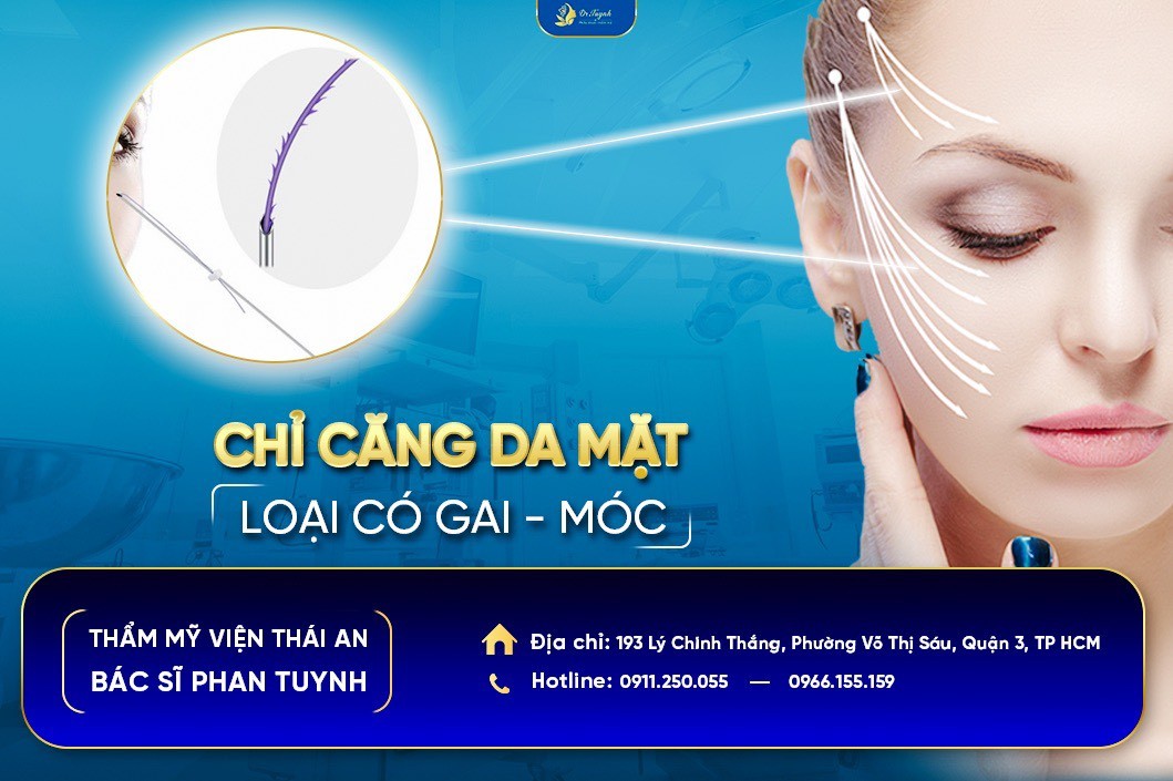 Căng da mặt bằng chỉ, chú ý phát huy ưu điểm ít sẹo