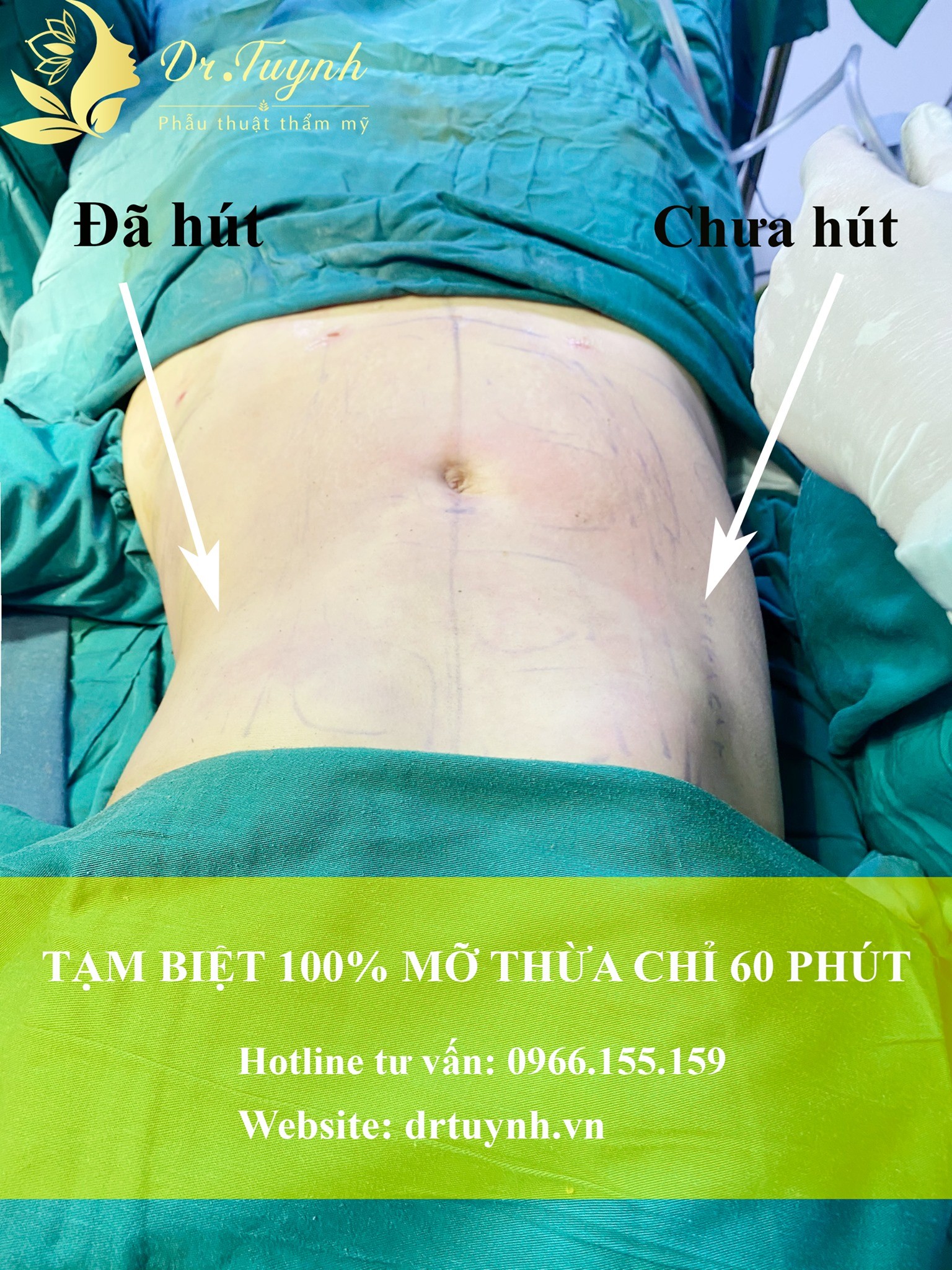 Thông tin cơ bản bạn cần biết trước khi đi hút mỡ