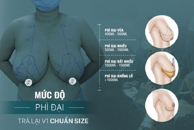 doi-tuong-nen-phau-thuat-nguc-phi-dai