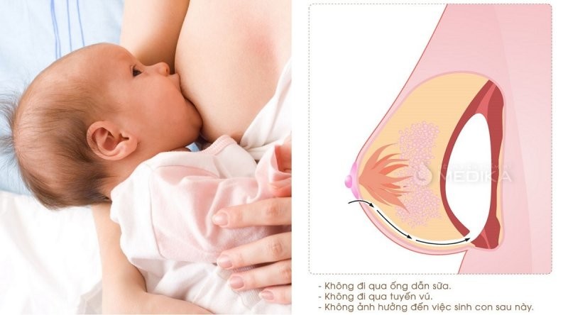 Sau phẫu thuật ngực có cho con bú được không?