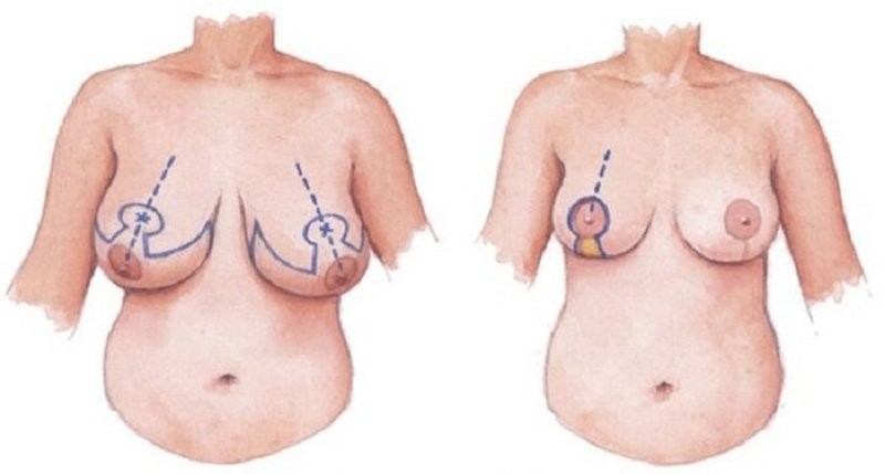 Nâng ngực chảy xệ: 5 sự thật chị em cần biết trước khi phẫu thuật