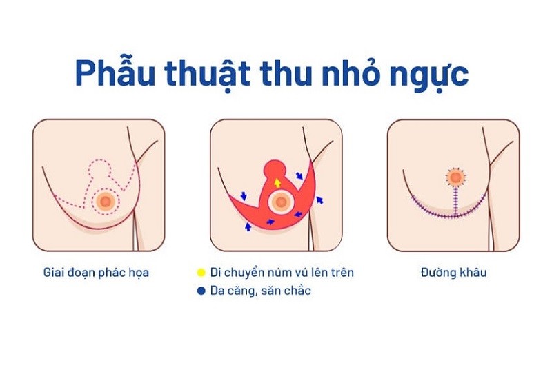 quy-trinh-phau-thuat-nguc-phi-dai