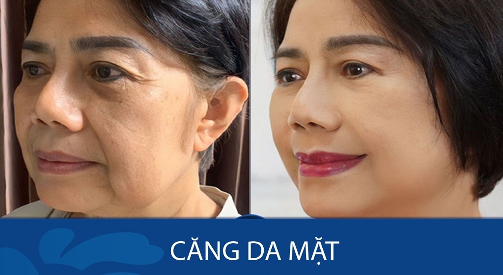 Phẫu thuật căng da mặt là gì? Những điều cần biết về căng da mặt phẫu thuật