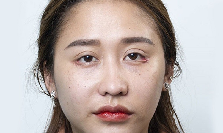 Sửa lại mí lỗi tốn kém bao nhiêu?