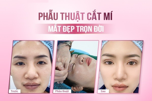 Có nên phẫu thuật cắt mắt 2 mí không? Cắt mắt 2 mí có đau không?