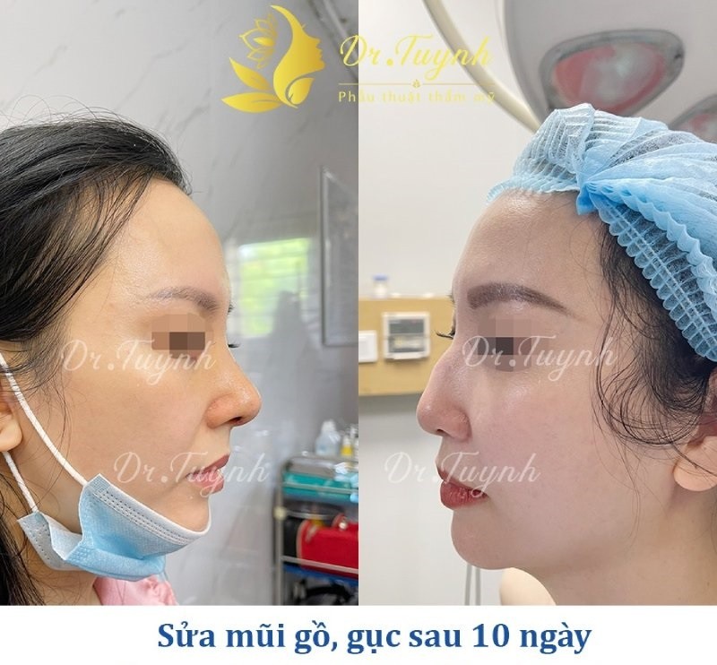 Nâng mũi sửa lại: Những lựa chọn quan trọng bạn nên biết