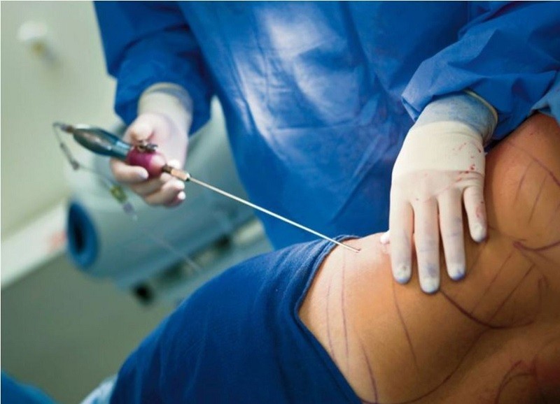Phù nề sau hút mỡ: Nguyên nhân và cách xử lý an toàn