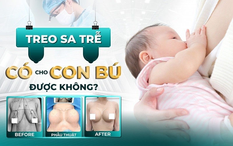 Treo sa trễ không đặt túi có cho con bú được không?
