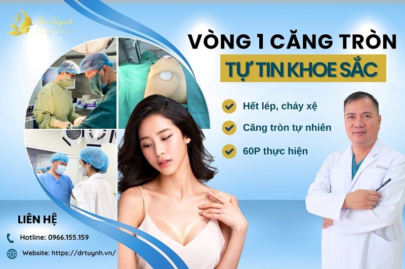 Ca sửa ngực: Tuyến - Túi Phân Ly (sa trễ tuyến và túi ngực lên cao)