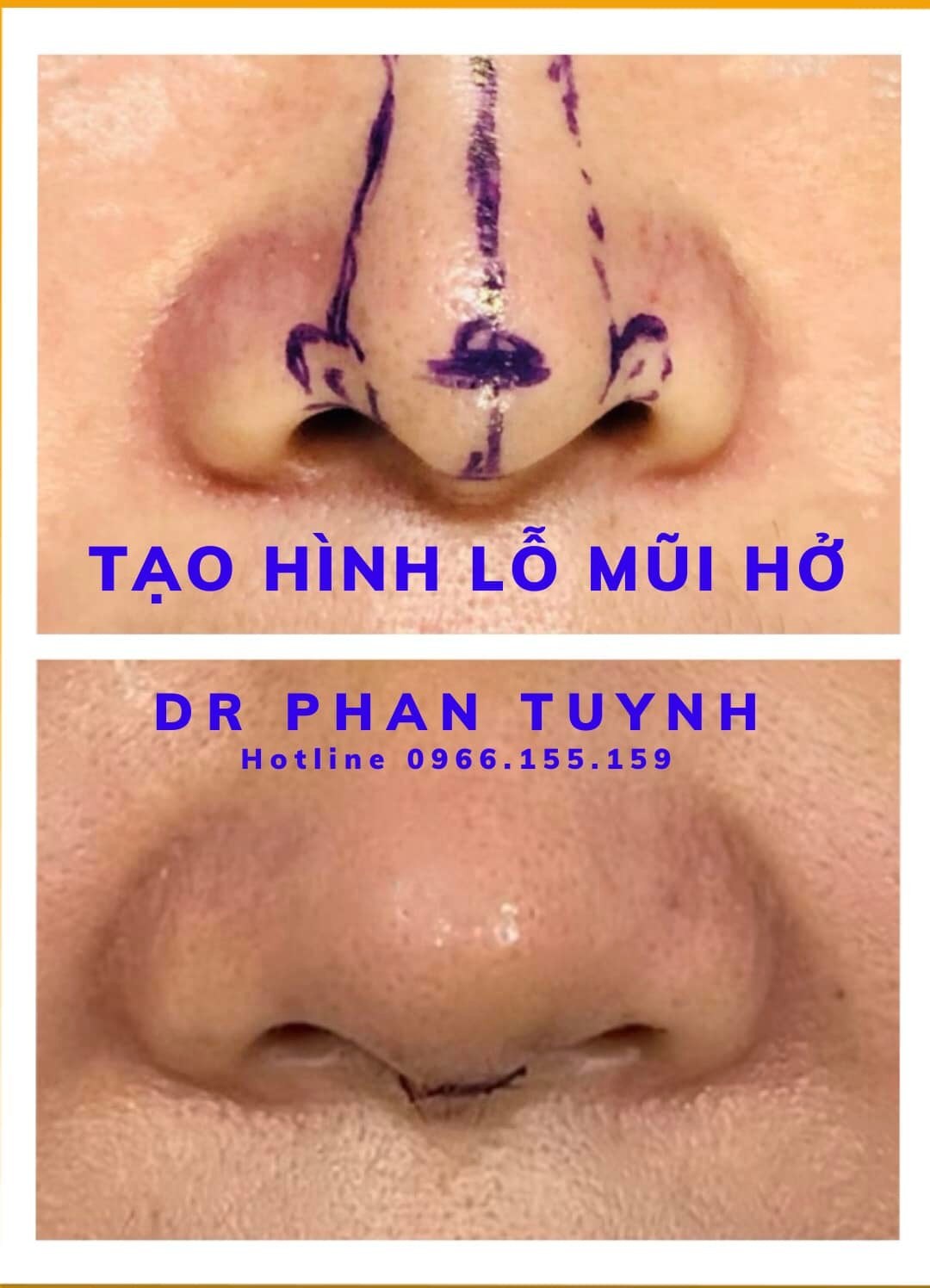 Phẫu thuật thay mũi, nghe lạ mà là quen